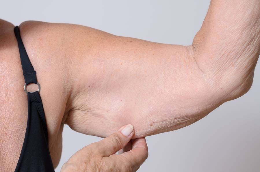 Elderly Lady Displaying The Loose Skin On Her Arm